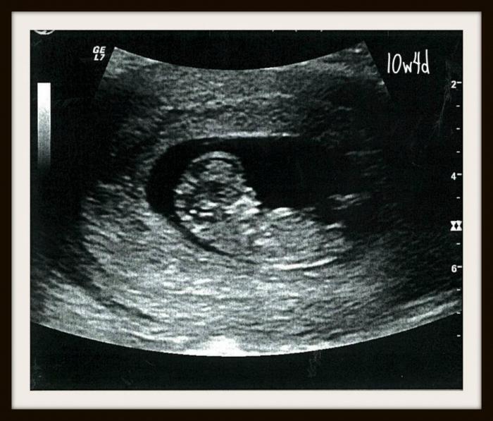Nosečnost 10 tednov fetalna fotografija