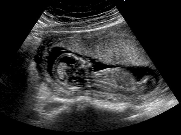 výsledky ultrazvuku