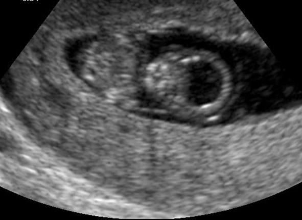 Ultrazvuk 6 týdnů těhotenství