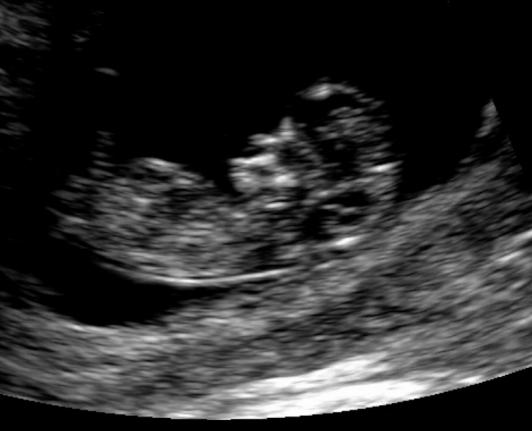těhotenství 6 týdnů ultrazvuková fotografie