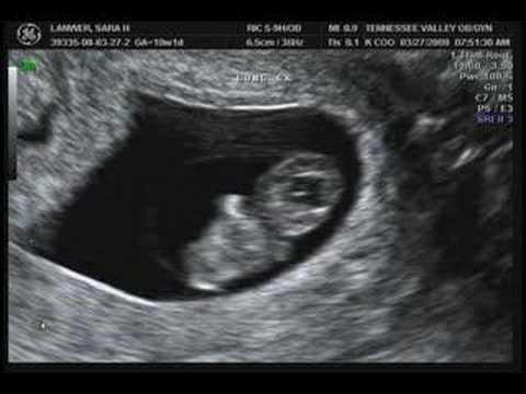 трудноћа 8 недеља фетус фотографија