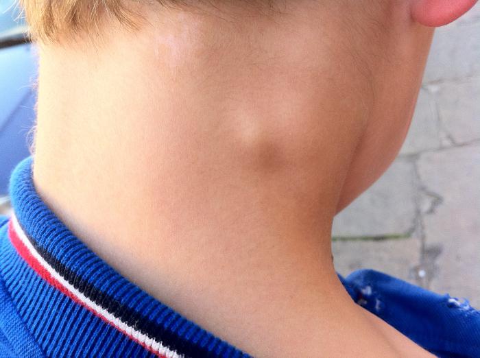 otrok ima povečane bezgavke v vratu