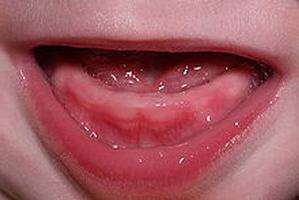 dijete koje ima zubalo ima simptome