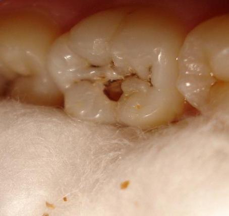 dziury w zębach