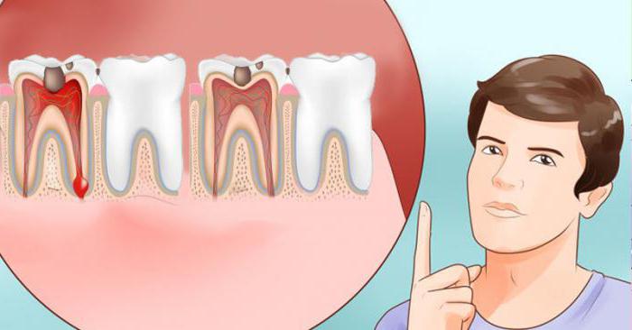 възпаление на дъвка над зъб при натискане