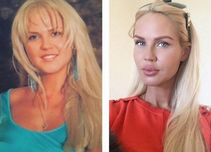 Maria Pogrebniak przed i po operacji plastycznej