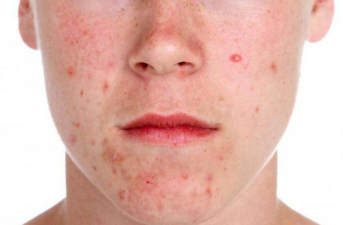 malattia dell'acne zheleznitsa