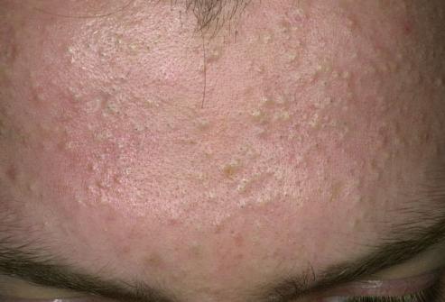 acne sulla fronte