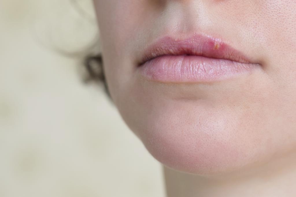 akne na ustnicah povzročajo in metode zdravljenja