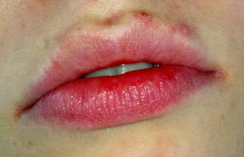 akne na ustnicah