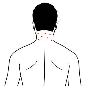 causa di acne sul collo
