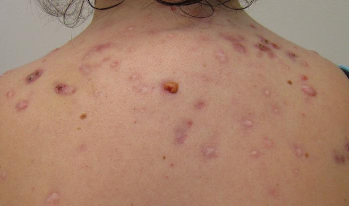 Pimples na ramenima