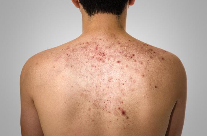 Pimples na leđima i ramenima