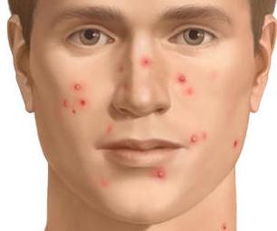 Acne acne