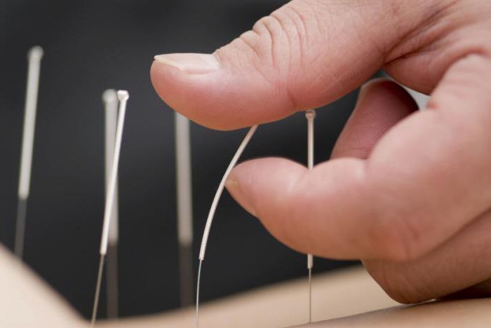 akupunktura kineski liječnici