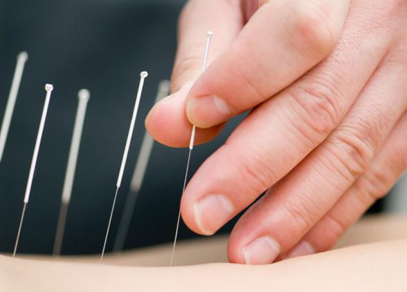 preglede akupunkture