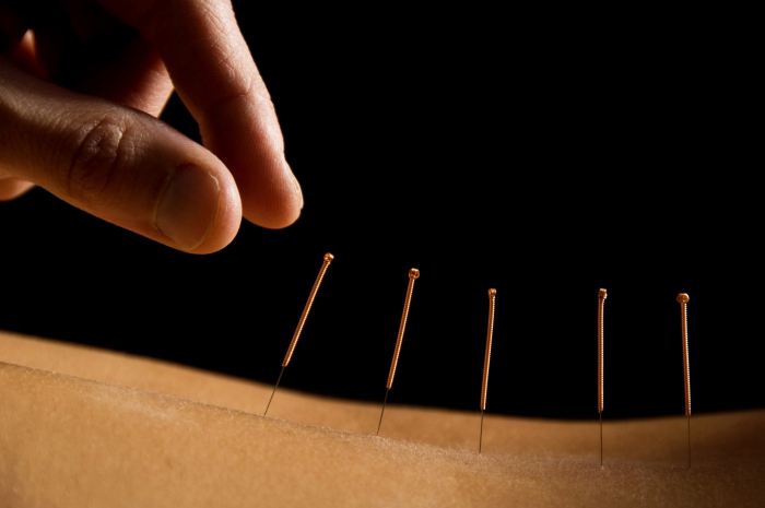 leczenie akupunktury