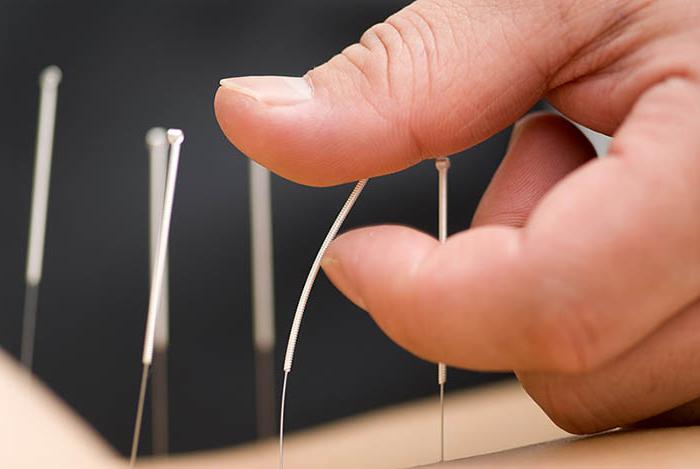 przeciwwskazania do akupunktury