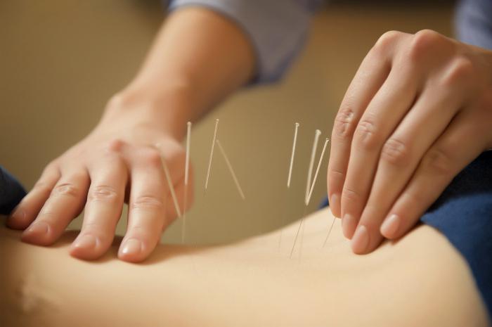 akupunktura kitajski