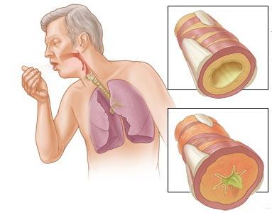 akutni bronhitis