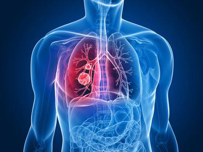 kako zdraviti akutni bronhitis