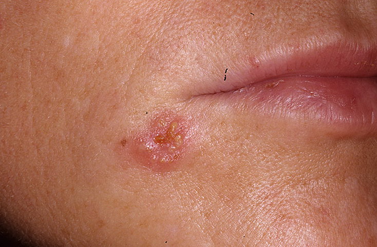 Herpes na obrazu