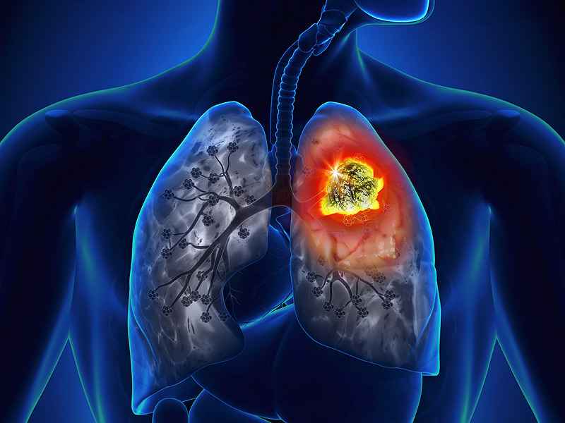 periferni pljučni adenokarcinom