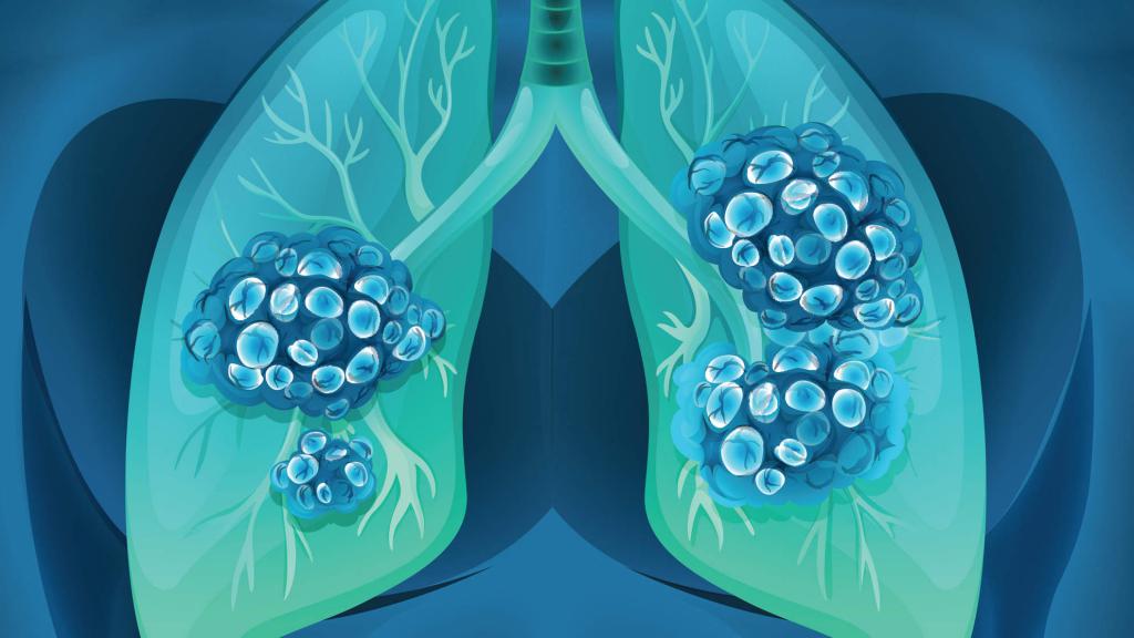 liječenje adenokarcinoma pluća
