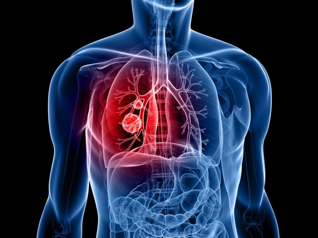 stadio polmonare dell'adenocarcinoma 4
