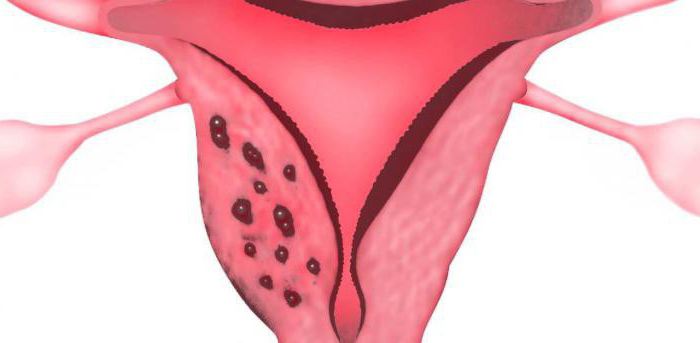 adenomiosi e differenze di endometriosi