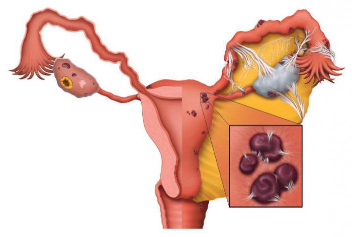 adenomioza in endometrioza, kakšna je razlika