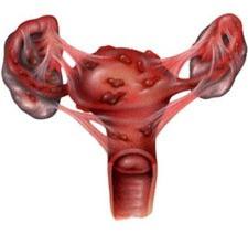 adheze v děloze
