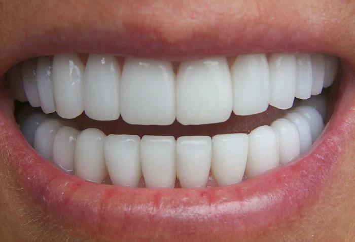 odbudowa zębów przednich