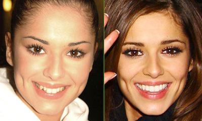 odbudowa zębów przed i po
