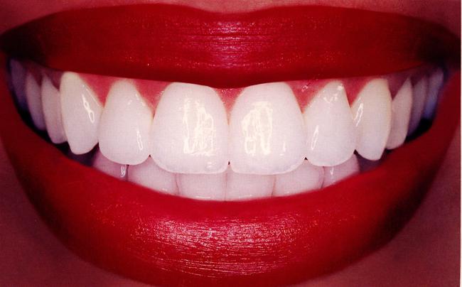 estetická obnova zubů