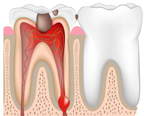 dolore al dente dopo un profondo trattamento della carie