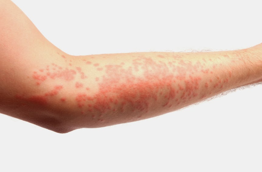 Manifestazioni di dermatite allergica da contatto