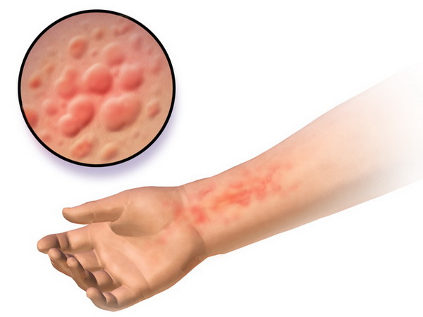 Symptomy alergické kontaktní dermatitidy