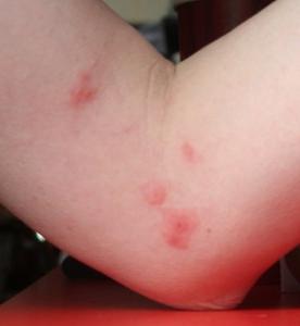 alergická dermatitida