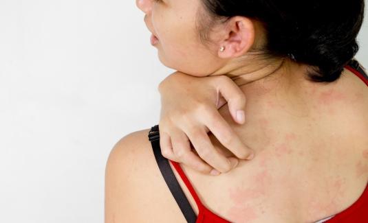 leczenie alergicznego zapalenia skóry