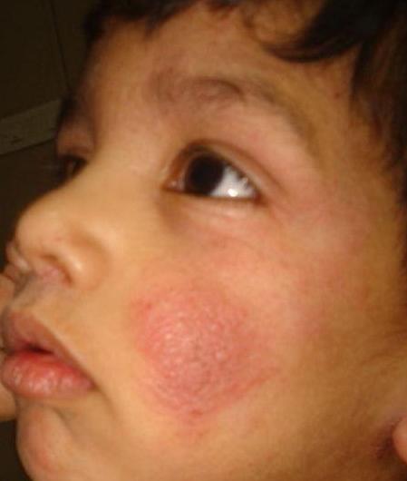 alergické dermatitidy při léčbě dětí
