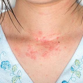 reakcja alergiczna skóry