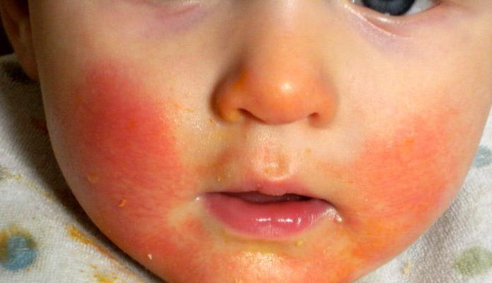 reazioni allergiche nei bambini