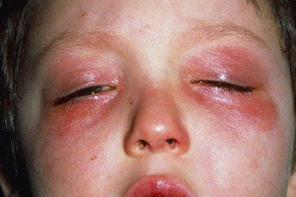 sintomi di allergia fredda