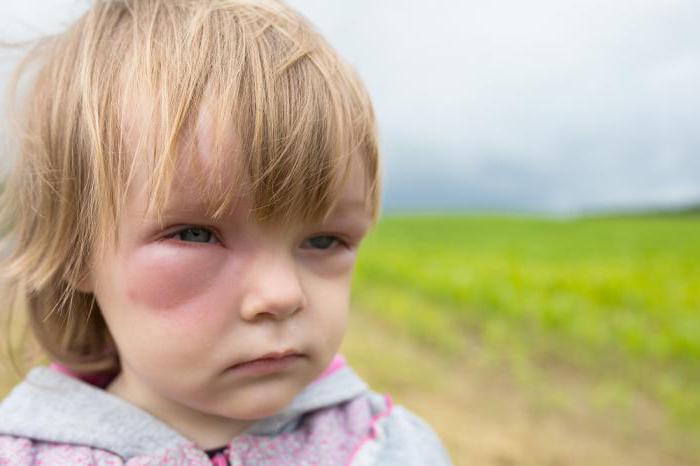 Alergia na komary u dziecka