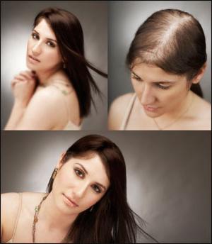 alopecia androgenetica nelle donne