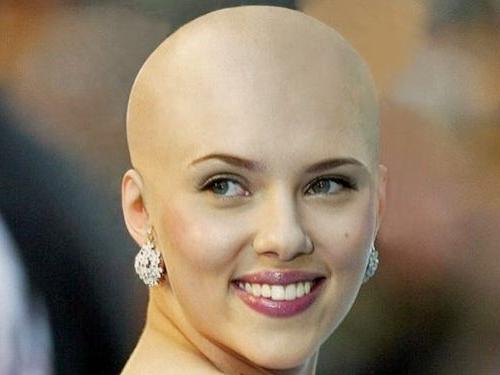 difuzna alopecija pri ženskah