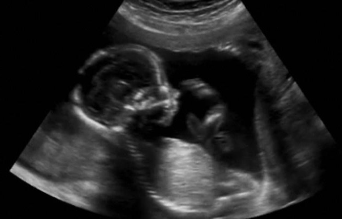 indice del liquido amniotico alla norma di 33 settimane