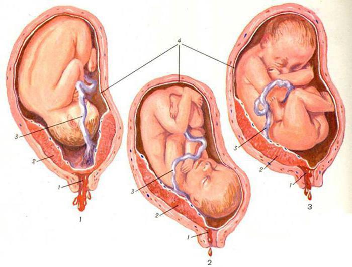 indukce amniotomie