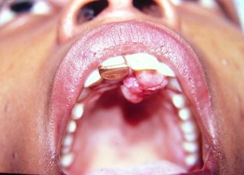 киста на лечението на венците